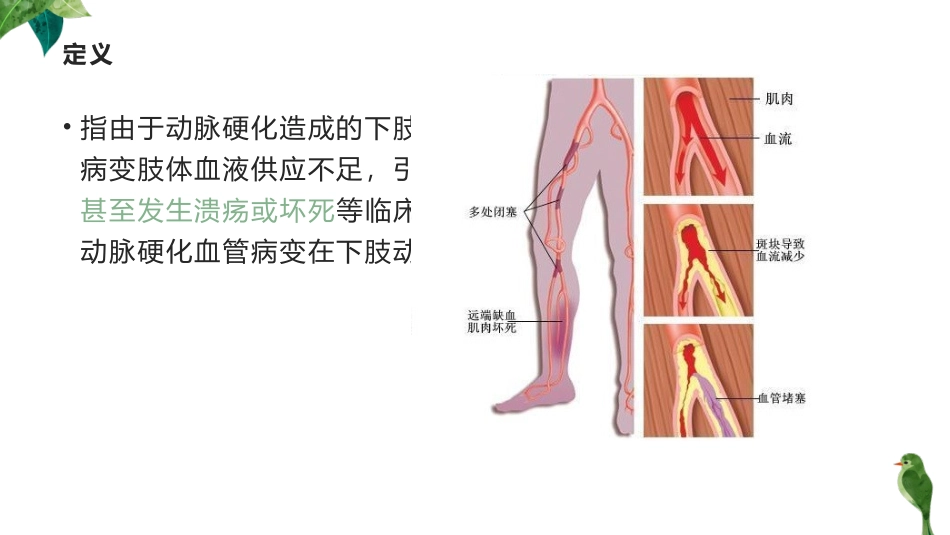 下肢动脉硬化闭塞症_第2页