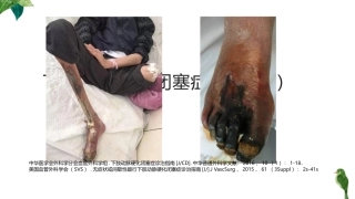 下肢动脉硬化闭塞症