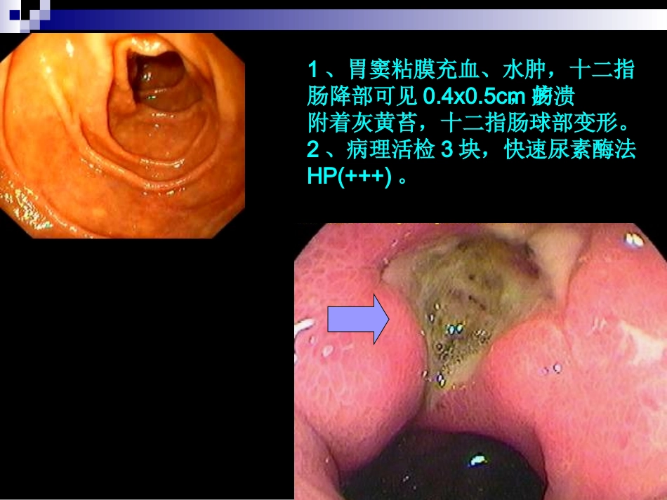 消化性溃疡教学课件_第3页