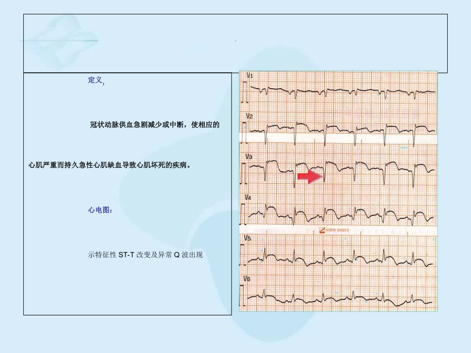 心肌梗死的心电图改变优质课件_第2页