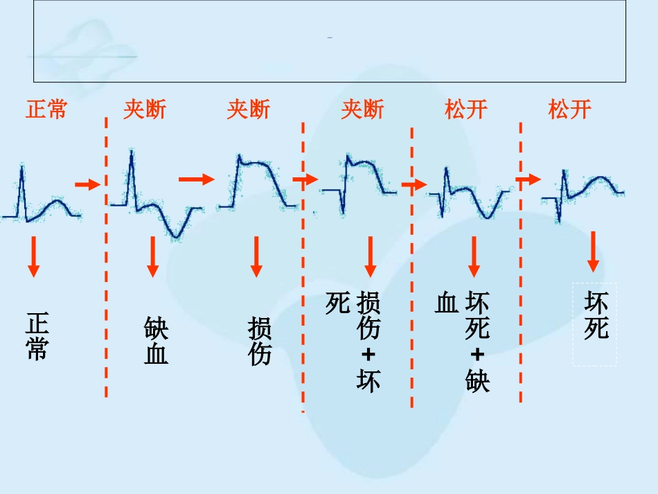 心肌梗死的心电图改变优质课件_第3页