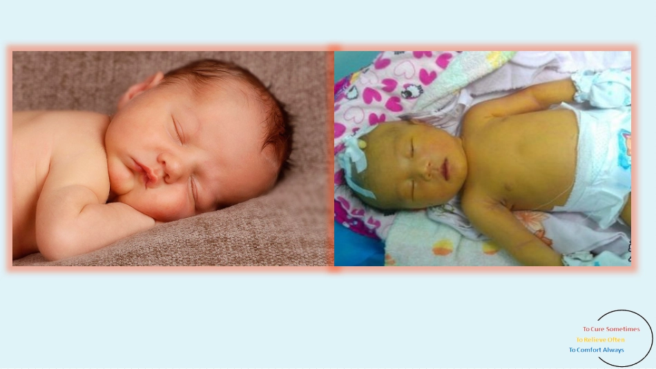 新生儿黄疸课件_第2页