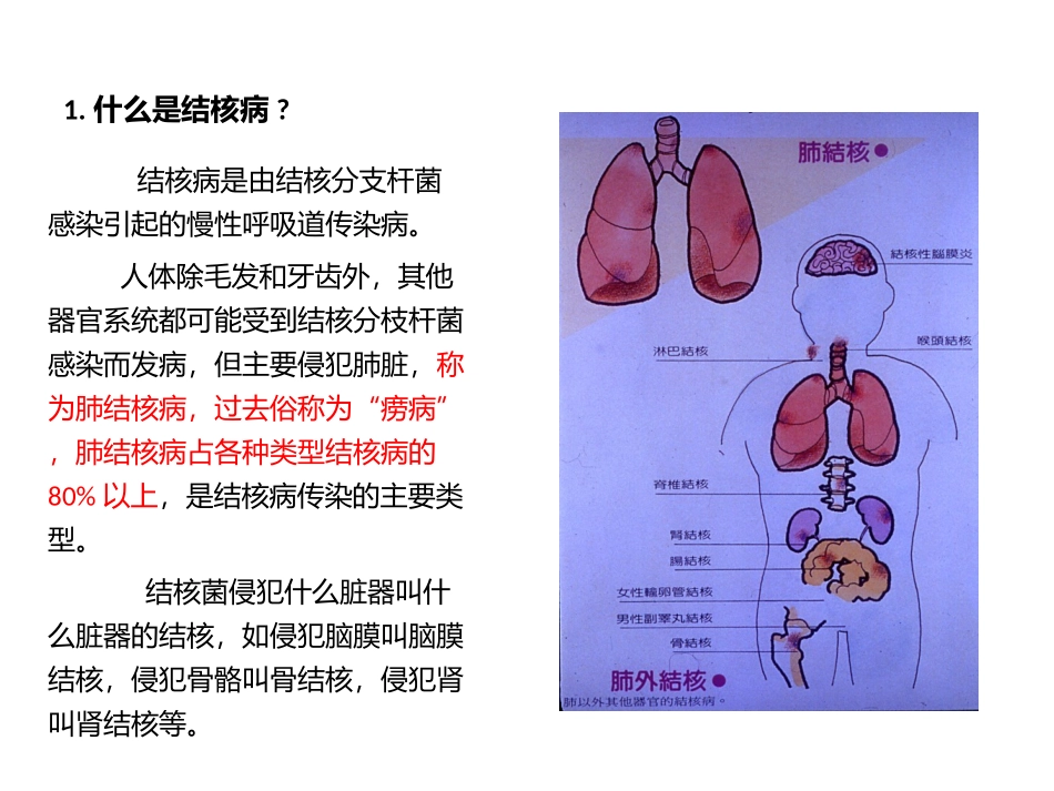 学校结核病防治知识_第2页