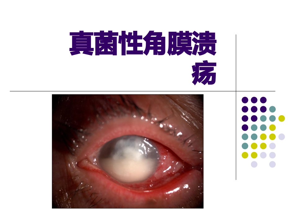 真菌性角膜炎_第1页