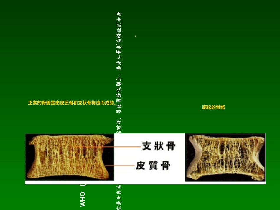 中国骨质疏松诊治的指南新_第3页