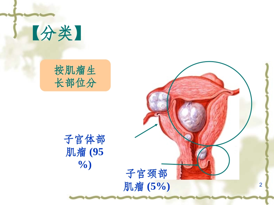 子宫肌瘤护理课件_第2页