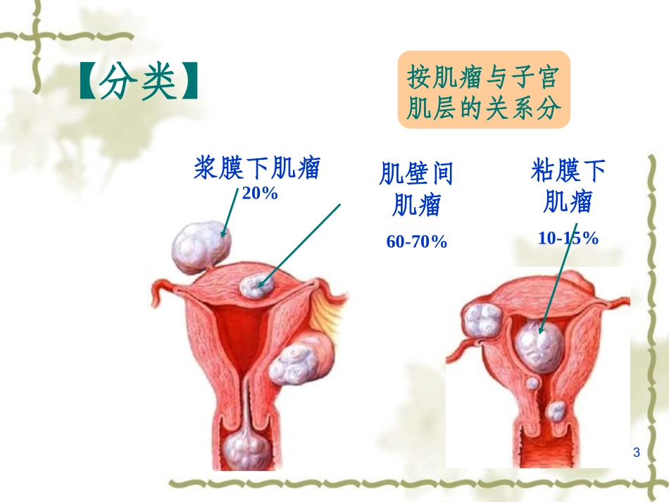 子宫肌瘤护理课件_第3页