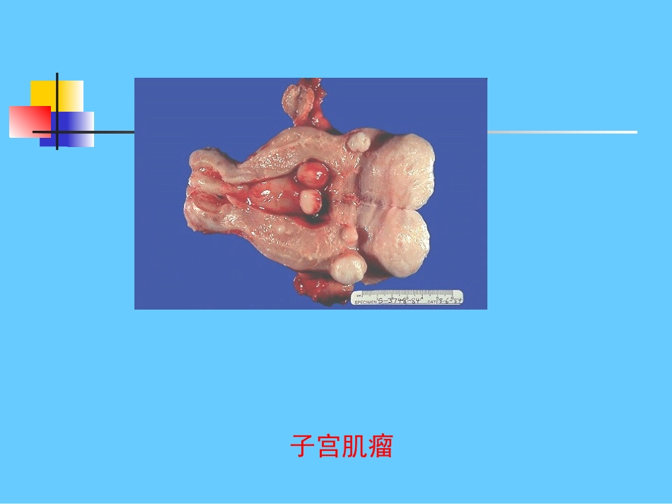 子宫肌瘤培训课件_第3页
