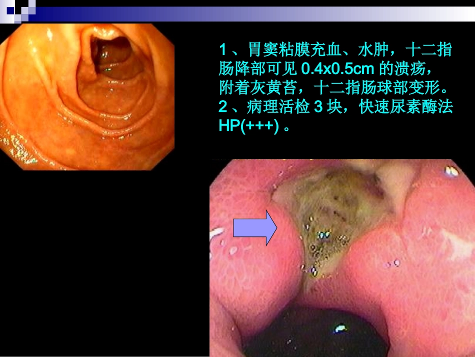 最新消化性溃疡教学主题讲座课件_第2页
