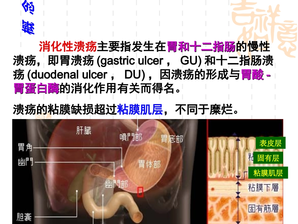 最新消化性溃疡教学主题讲座课件_第3页