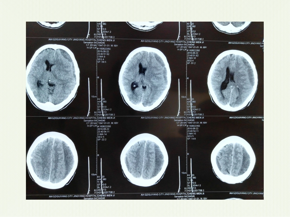 阿托伐他汀钙治疗慢性硬膜下血肿的临床运用汇报课件_第2页