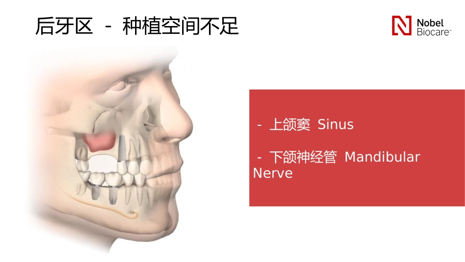 安稳种植安心之选NobelBiocare后牙解决方案_第3页