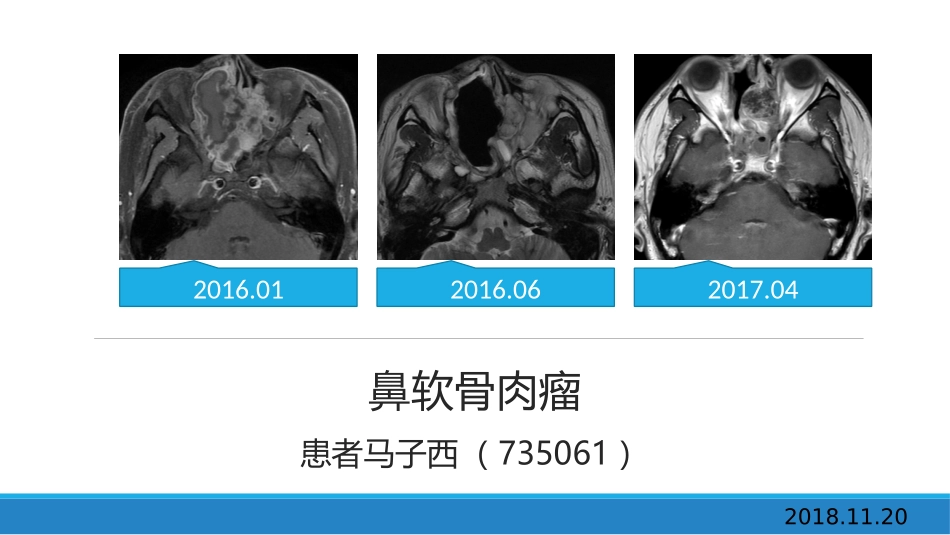 鼻软骨肉瘤病例_第1页