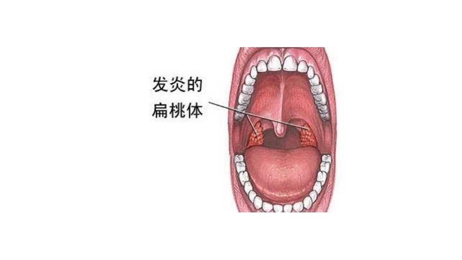 扁桃体术后护理常规_第2页