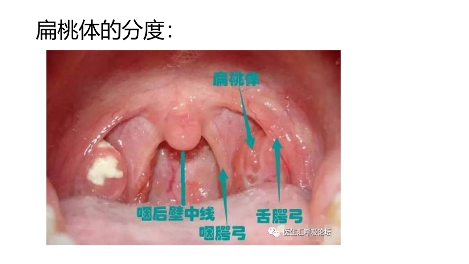 扁桃体术后护理常规_第3页