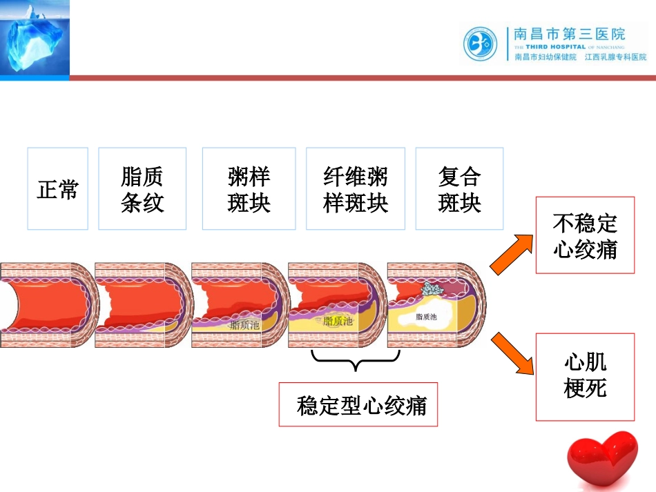 不稳定心绞痛查房_第3页