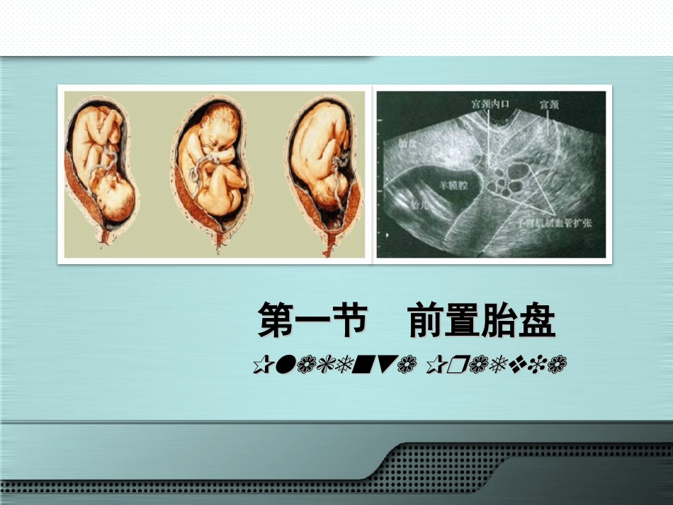 产科前置胎盘_第2页