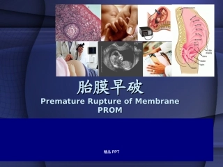产科胎膜早破产科学课件