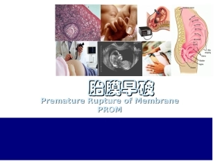 产科胎膜早破产科学完整课件