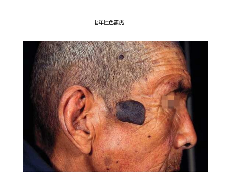 常见体表肿瘤的诊疗和处置_第3页