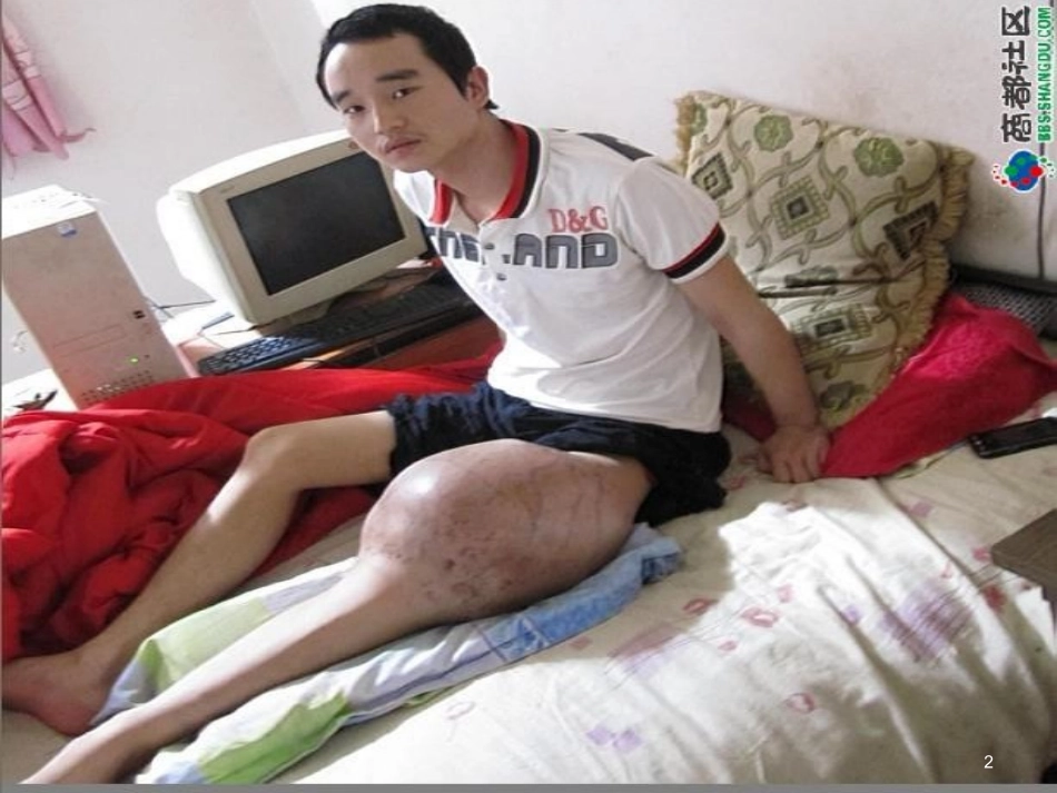 成骨肉瘤课件_第2页