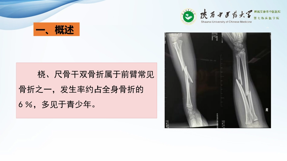 尺桡骨双骨折_第3页