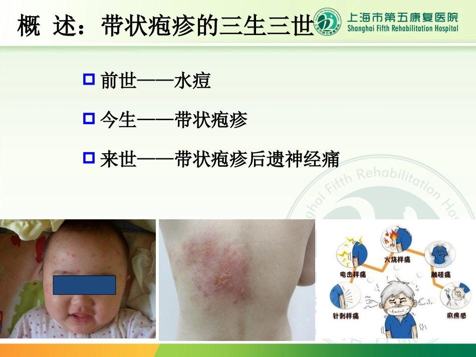 带状疱疹后神经痛的诊治_第2页
