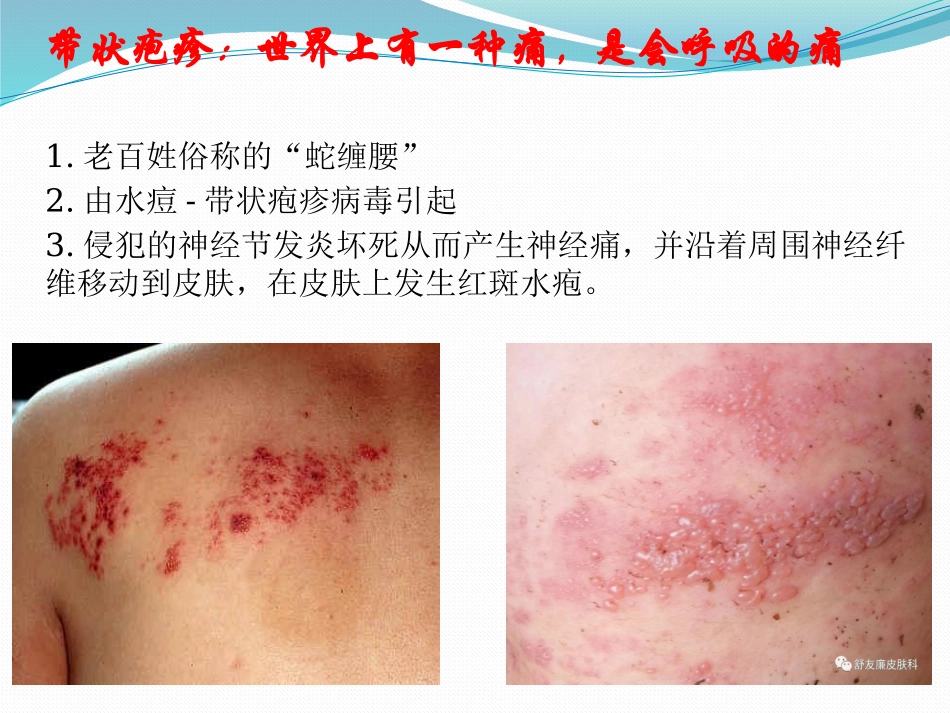 带状疱疹健康宣教_第2页