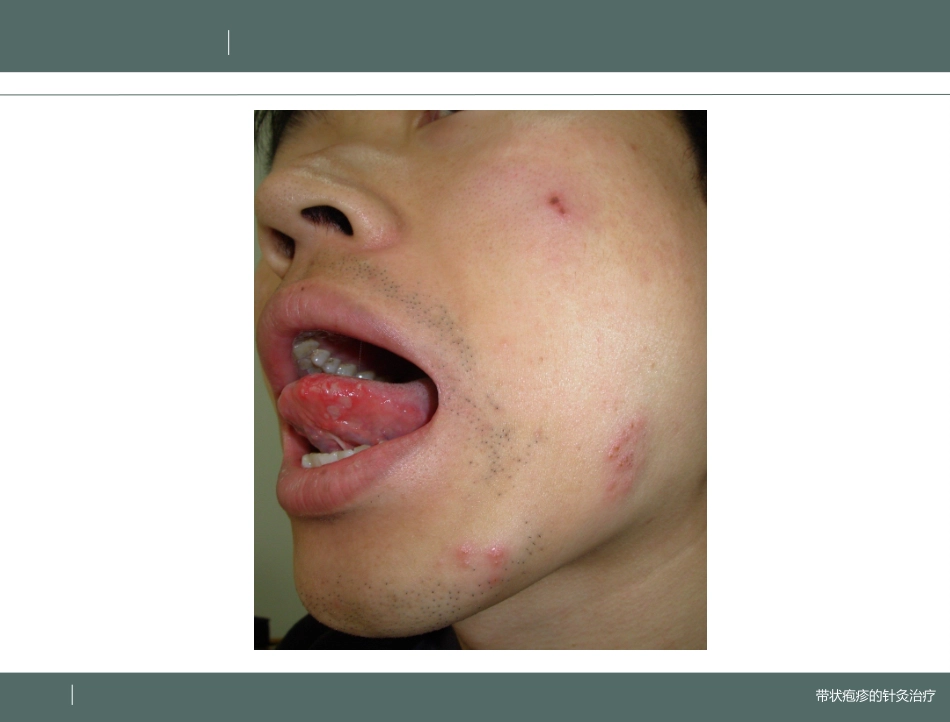 带状疱疹中医治疗课件_第3页