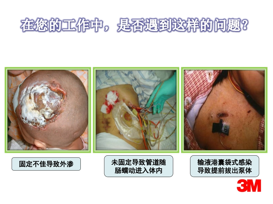 导管固定方案_第3页