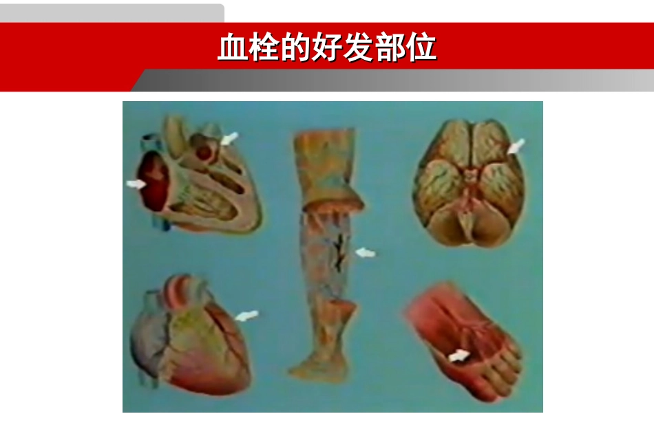 动脉血栓和静脉血栓治疗的比较讲解_第3页