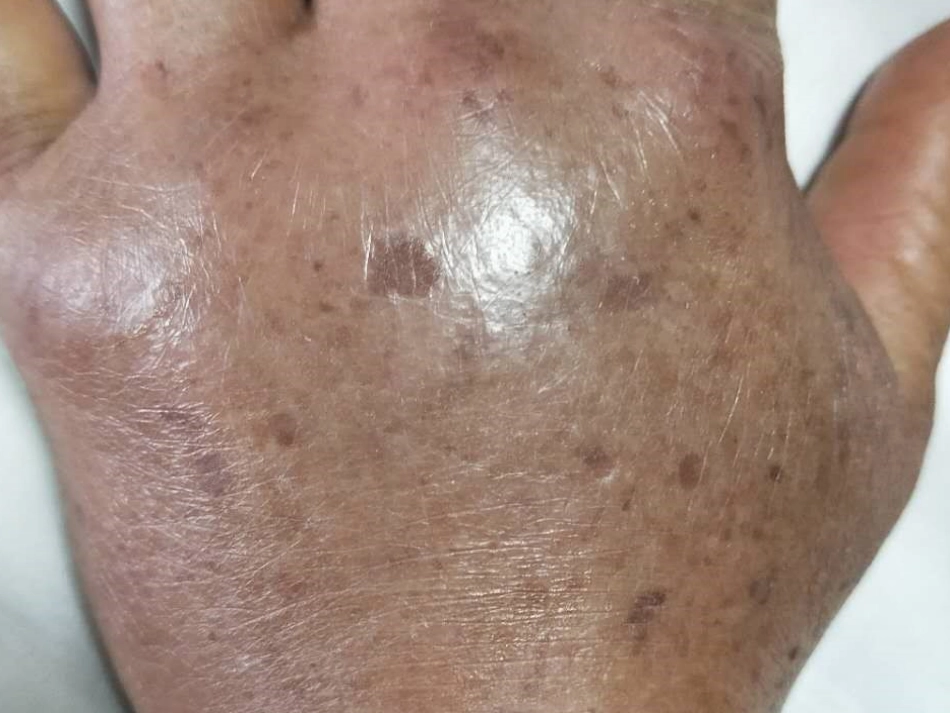 毒蛇咬伤护理查房_第3页