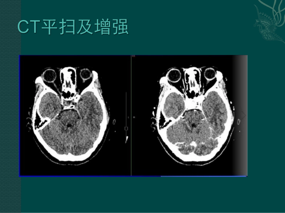 多结节和空泡状神经元肿瘤_第2页