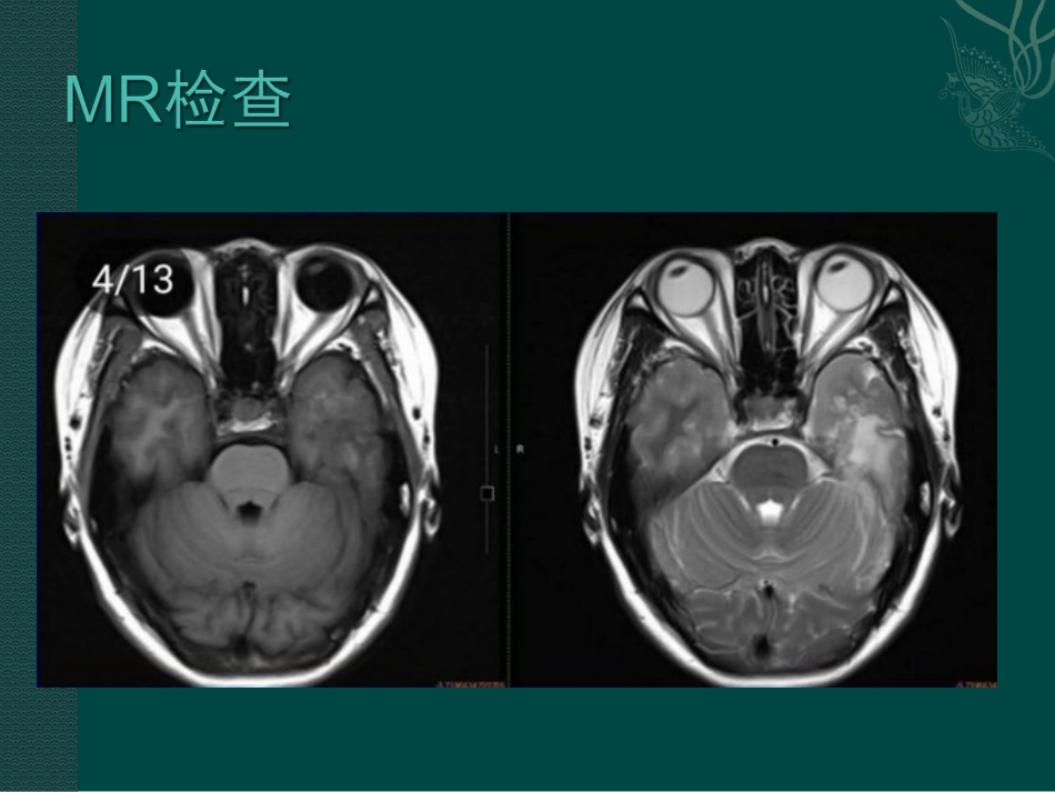 多结节和空泡状神经元肿瘤_第3页