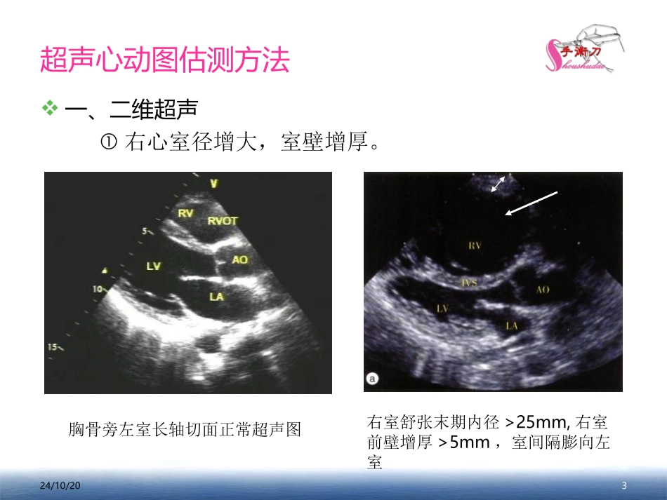 肺动脉高压的超声估测量方法_第3页