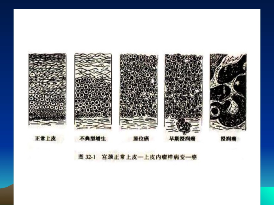 妇产科子宫颈癌_第2页
