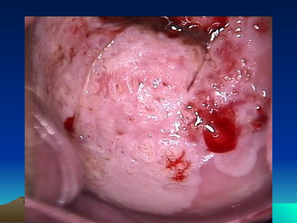 妇产科子宫颈癌_第3页