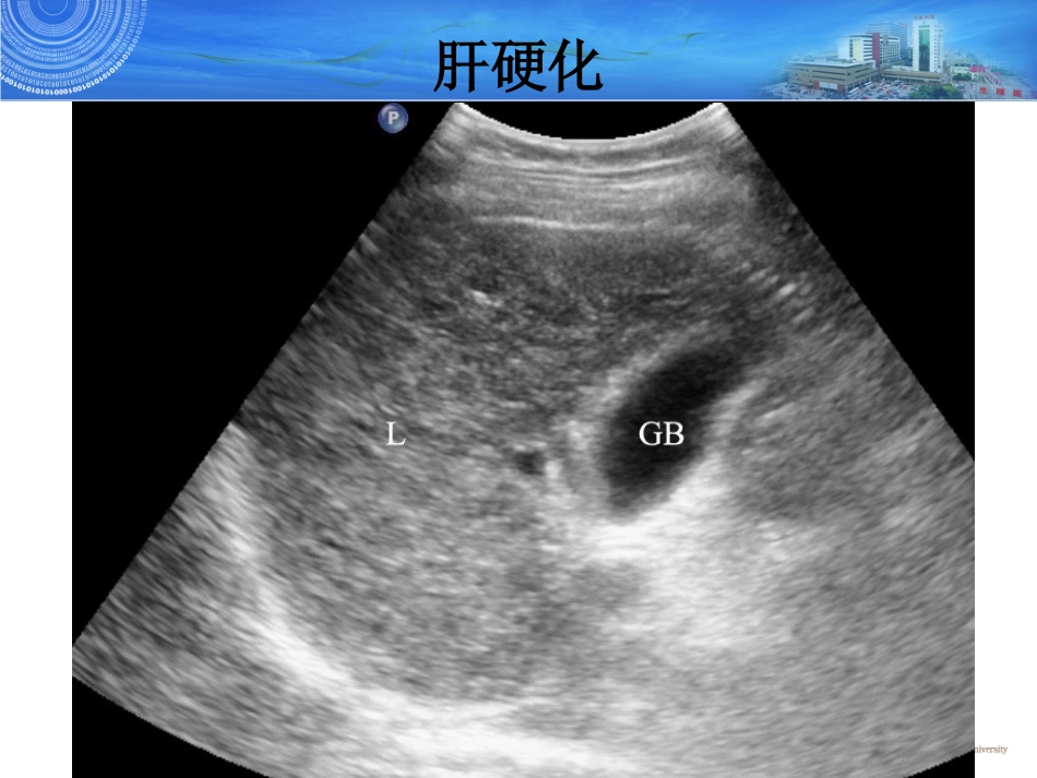 腹部常见疾病超声诊疗技能_第3页