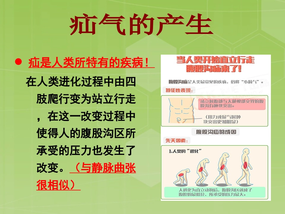 腹股沟疝的陷阱滑疝_第2页