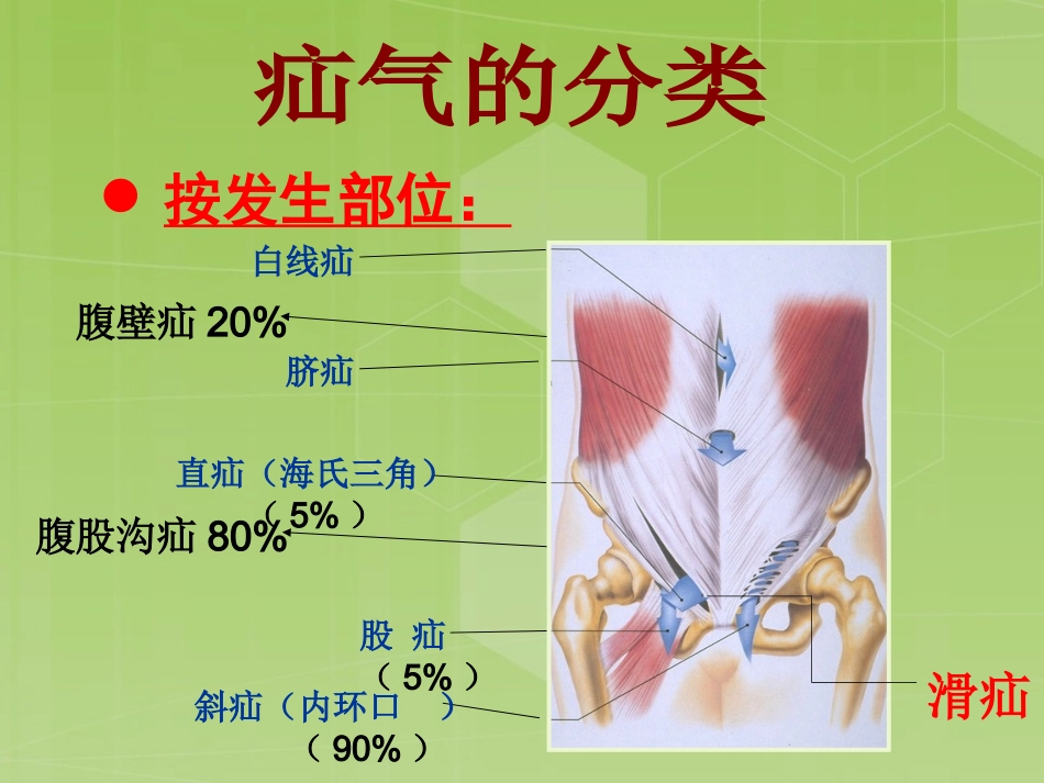 腹股沟疝的陷阱滑疝_第3页