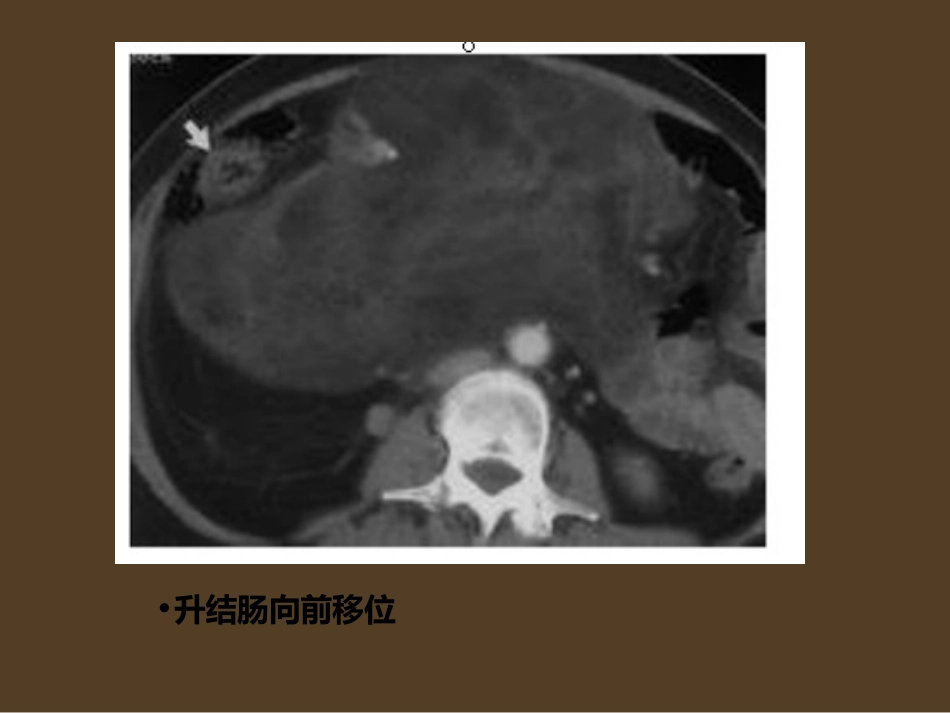 腹膜后神经源性肿瘤最新_第3页