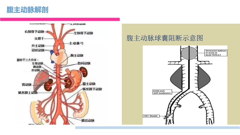 腹主动脉阻断术_第3页