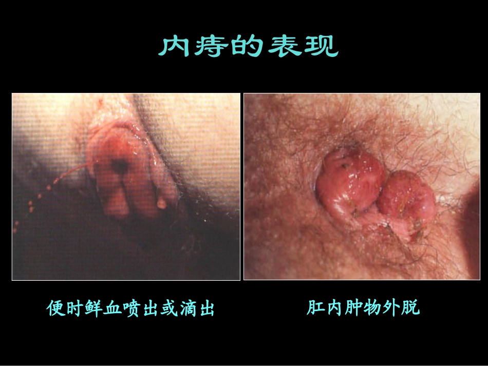肛肠疾病基本知识_第3页