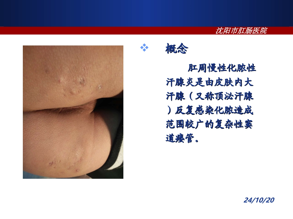 肛周慢性化脓性汗腺炎的诊疗和治疗_第2页