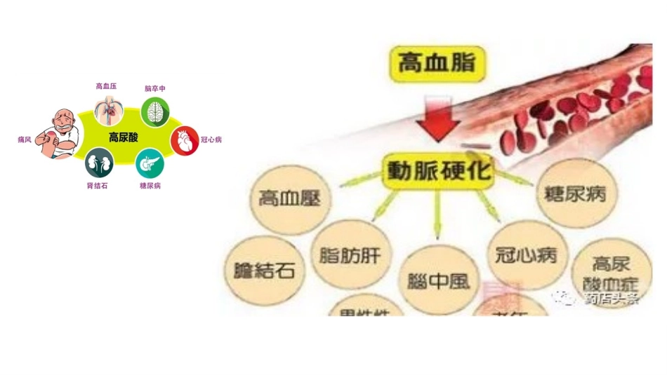 高尿酸血症上刘昂_第2页