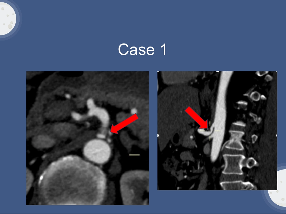 弓状韧带综合征_第3页