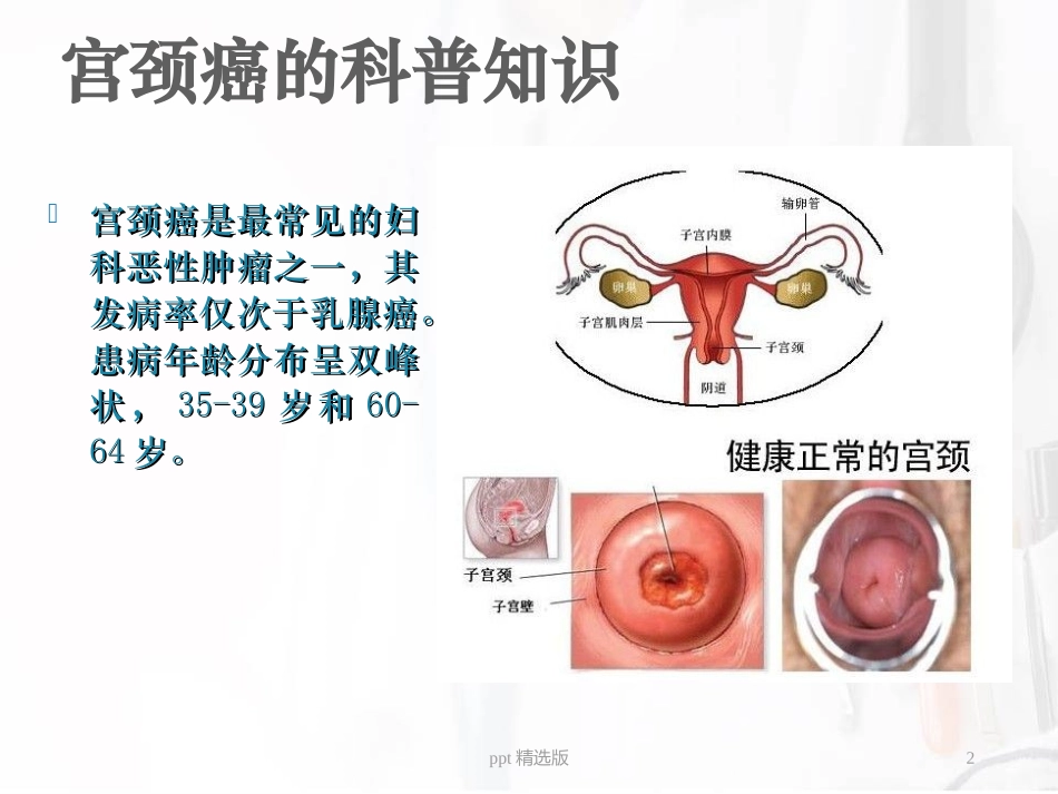 宫颈癌广泛性子宫切除盆腔淋巴结清扫手术配合课件_第2页