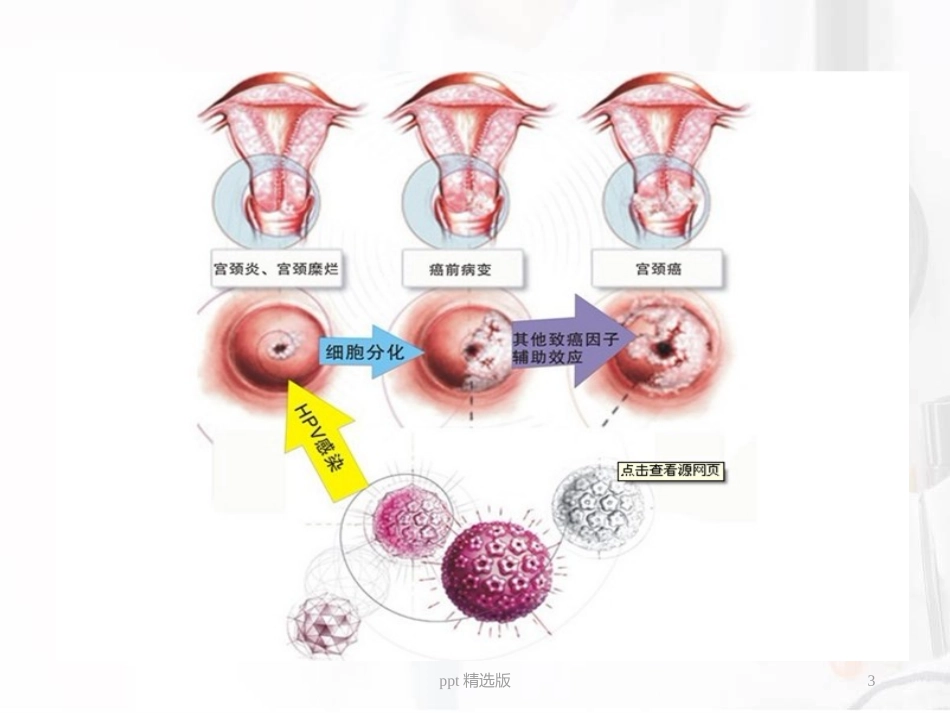 宫颈癌广泛性子宫切除盆腔淋巴结清扫手术配合课件_第3页