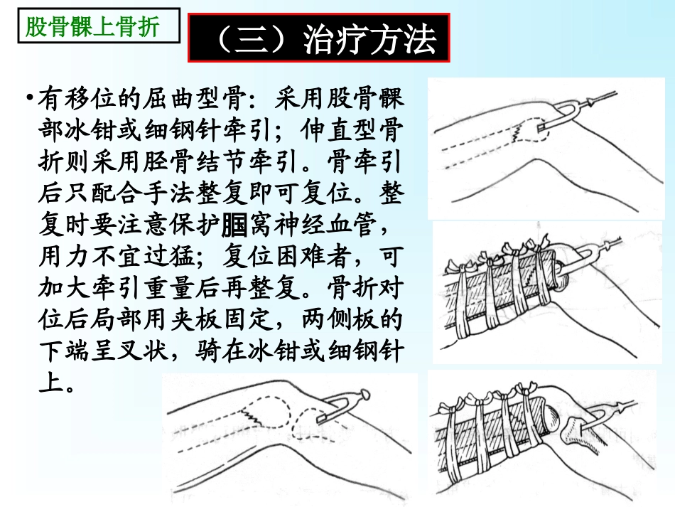 股骨髁间骨折髌骨骨折_第3页