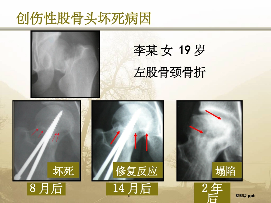 股骨头坏死定义_第3页